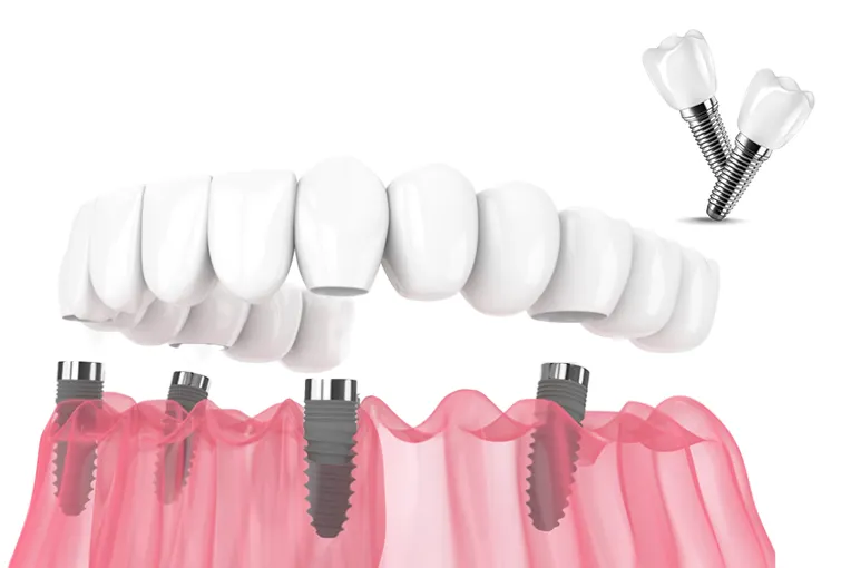 All-on-4 Implants Antalya Turkey