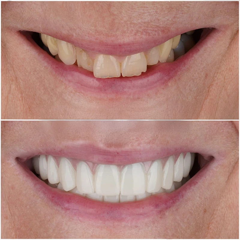 All-on-4 Dental Implant Turkey