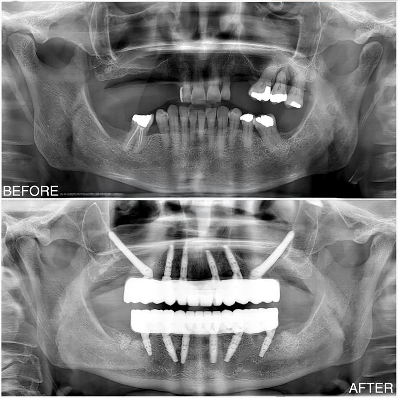 All-on-4 Implant Turkey
