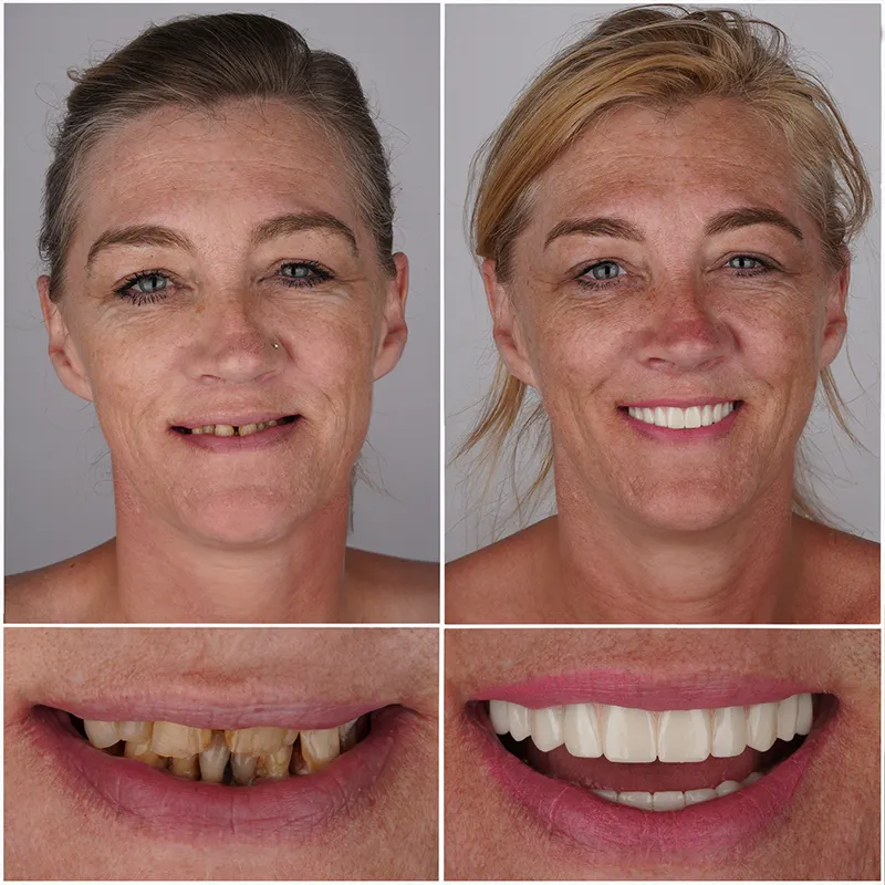 All-on-6 Dental Implant Turkey